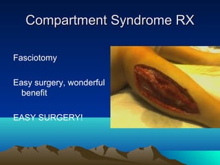 Compartment Syndrome RXCompartment Syndrome RX
Fasciotomy
Easy surgery, wonderful
benefit
EASY SURGERY!
 