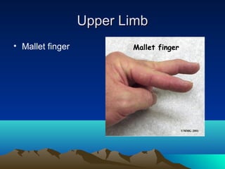 Upper LimbUpper Limb
• Mallet finger
 