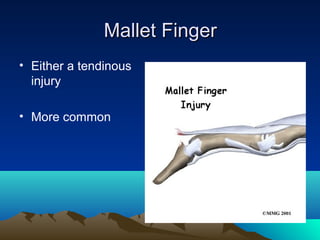 Mallet FingerMallet Finger
• Either a tendinous
injury
• More common
 