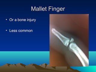 Mallet FingerMallet Finger
• Or a bone injury
• Less common
 