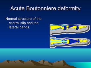 Acute Boutonniere deformityAcute Boutonniere deformity
Normal structure of the
central slip and the
lateral bands
 