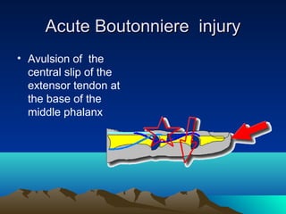 Acute Boutonniere injuryAcute Boutonniere injury
• Avulsion of the
central slip of the
extensor tendon at
the base of the
middle phalanx
 