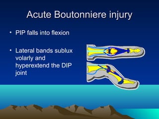 Acute Boutonniere injuryAcute Boutonniere injury
• PIP falls into flexion
• Lateral bands sublux
volarly and
hyperextend the DIP
joint
 