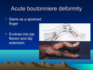 Acute boutonniere deformityAcute boutonniere deformity
• Starts as a sprained
finger
• Evolves into pip
flexion and dip
extension
 