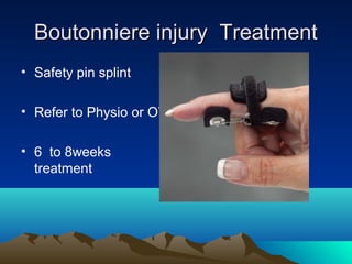 Boutonniere injury TreatmentBoutonniere injury Treatment
• Safety pin splint
• Refer to Physio or OT
• 6 to 8weeks
treatment
 