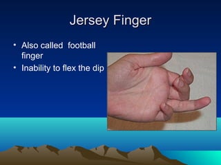 Jersey FingerJersey Finger
• Also called football
finger
• Inability to flex the dip
 