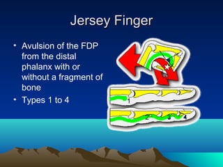 Jersey FingerJersey Finger
• Avulsion of the FDP
from the distal
phalanx with or
without a fragment of
bone
• Types 1 to 4
 