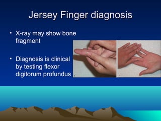Jersey Finger diagnosisJersey Finger diagnosis
• X-ray may show bone
fragment
• Diagnosis is clinical
by testing flexor
digitorum profundus
 