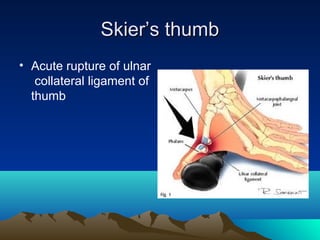 Skier’s thumbSkier’s thumb
• Acute rupture of ulnar
collateral ligament of
thumb
 