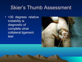 Skier’s Thumb AssessmentSkier’s Thumb Assessment
• >30 degrees relative
instability is
diagnostic of
complete ulnar
collateral ligament
tear
 