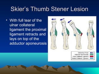 Skier’s Thumb Stener LesionSkier’s Thumb Stener Lesion
• With full tear of the
ulnar collateral
ligament the proximal
ligament retracts and
lays on top of the
adductor aponeurosis
 