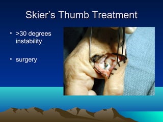 Skier’s Thumb TreatmentSkier’s Thumb Treatment
• >30 degrees
instability
• surgery
 