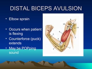 DISTAL BICEPS AVULSIONDISTAL BICEPS AVULSION
• Elbow sprain
• Occurs when patient
is flexing
• Counterforce (puck)
extends
• May be POPping
sound
 