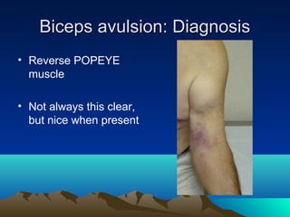 Biceps avulsion: DiagnosisBiceps avulsion: Diagnosis
• Reverse POPEYE
muscle
• Not always this clear,
but nice when present
 