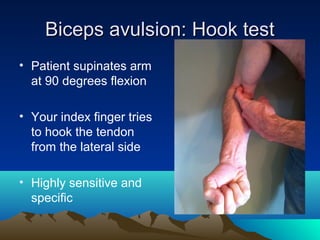 Biceps avulsion: Hook testBiceps avulsion: Hook test
• Patient supinates arm
at 90 degrees flexion
• Your index finger tries
to hook the tendon
from the lateral side
• Highly sensitive and
specific
 