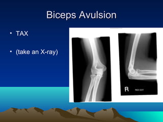 Biceps AvulsionBiceps Avulsion
• TAX
• (take an X-ray)
 