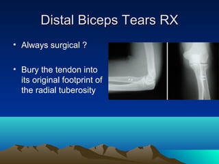 Distal Biceps Tears RXDistal Biceps Tears RX
• Always surgical ?
• Bury the tendon into
its original footprint of
the radial tuberosity
 