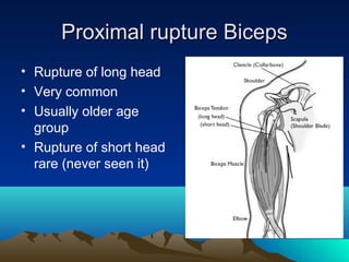 Proximal rupture BicepsProximal rupture Biceps
• Rupture of long head
• Very common
• Usually older age
group
• Rupture of short head
rare (never seen it)
 