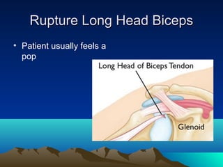 Rupture Long Head BicepsRupture Long Head Biceps
• Patient usually feels a
pop
 