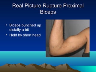 Real Picture Rupture ProximalReal Picture Rupture Proximal
BicepsBiceps
• Biceps bunched up
distally a bit
• Held by short head
 