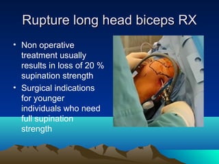 Rupture long head biceps RXRupture long head biceps RX
• Non operative
treatment usually
results in loss of 20 %
supination strength
• Surgical indications
for younger
individuals who need
full supination
strength
 