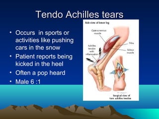 Tendo Achilles tearsTendo Achilles tears
• Occurs in sports or
activities like pushing
cars in the snow
• Patient reports being
kicked in the heel
• Often a pop heard
• Male 6 :1
 
