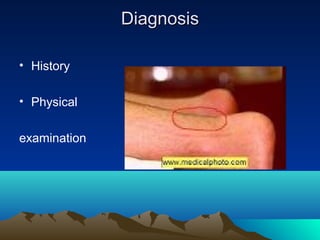• History
• Physical
examination
DiagnosisDiagnosis
 