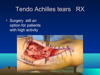 Tendo Achilles tears RXTendo Achilles tears RX
• Surgery still an
option for patients
with high activity
 