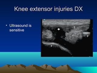 Knee extensor injuries DXKnee extensor injuries DX
• Ultrasound is
sensitive
 