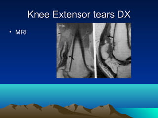 Knee Extensor tears DXKnee Extensor tears DX
• MRI
 