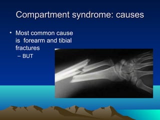 Compartment syndrome: causesCompartment syndrome: causes
• Most common cause
is forearm and tibial
fractures
– BUT
 