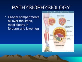 PATHYSIOPHYSIOLOGYPATHYSIOPHYSIOLOGY
• Fascial compartments
all over the limbs,
most clearly in
forearm and lower leg
 