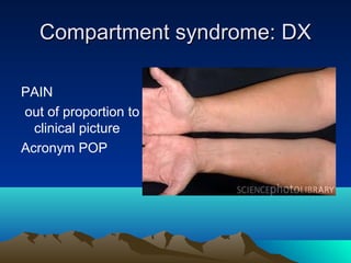 Compartment syndrome: DXCompartment syndrome: DX
PAIN
out of proportion to the
clinical picture
Acronym POP
 