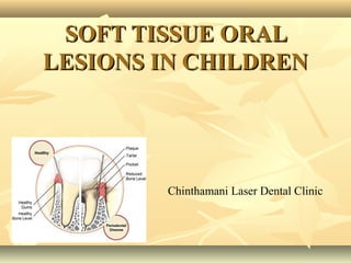 SOFT TISSUE ORAL
LESIONS IN CHILDREN

Chinthamani Laser Dental Clinic

 