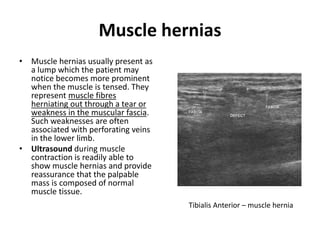 Muscle hernias 
• Muscle hernias usually present as 
a lump which the patient may 
notice becomes more prominent 
when the muscle is tensed. They 
represent muscle fibres 
herniating out through a tear or 
weakness in the muscular fascia. 
Such weaknesses are often 
associated with perforating veins 
in the lower limb. 
• Ultrasound during muscle 
contraction is readily able to 
show muscle hernias and provide 
reassurance that the palpable 
mass is composed of normal 
muscle tissue. 
Tibialis Anterior – muscle hernia 
 