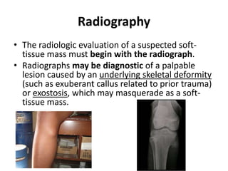 Radiography 
• The radiologic evaluation of a suspected soft-tissue 
mass must begin with the radiograph. 
• Radiographs may be diagnostic of a palpable 
lesion caused by an underlying skeletal deformity 
(such as exuberant callus related to prior trauma) 
or exostosis, which may masquerade as a soft-tissue 
mass. 
 