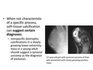 • When not characteristic 
of a specific process, 
soft-tissue calcification 
can suggest certain 
diagnoses. 
– nonspecific dystrophic 
calcifications in a slowly 
growing lower extremity 
mass in a young adult 
should suggest a synovial 
sarcoma as the diagnosis 
of exclusion. 
17-year-old girl with synovial sarcoma of foot 
who presented with slowly growing painless 
mass. 
 