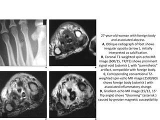 27-year-old woman with foreign body 
and associated abscess. 
A, Oblique radiograph of foot shows 
irregular opacity (arrow ), initially 
interpreted as calcification. 
B, Coronal T1-weighted spin-echo MR 
image (600/15, TR/TE) shows prominent 
signal void (asterisk ), with “parenthetic” 
artifact, compatible with foreign body. 
C, Corresponding conventional T2- 
weighted spin-echo MR image (2500/80) 
shows foreign body (asterisk ) with 
associated inflammatory change. 
D, Gradient-echo MR image (15/12, 15° 
flip angle) shows “blooming” (asterisk ) 
caused by greater magnetic susceptibility. 
 
