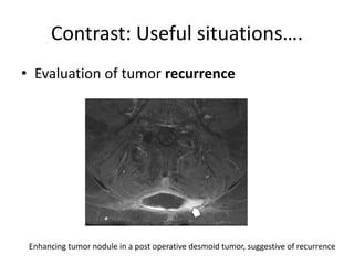 Contrast: Useful situations…. 
• Evaluation of tumor recurrence 
Enhancing tumor nodule in a post operative desmoid tumor, suggestive of recurrence 
 
