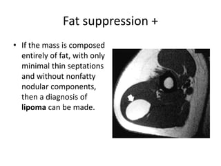 Fat suppression + 
• If the mass is composed 
entirely of fat, with only 
minimal thin septations 
and without nonfatty 
nodular components, 
then a diagnosis of 
lipoma can be made. 
 