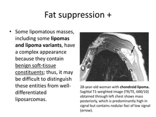 Fat suppression + 
• Some lipomatous masses, 
including some lipomas 
and lipoma variants, have 
a complex appearance 
because they contain 
benign soft-tissue 
constituents; thus, it may 
be difficult to distinguish 
these entities from well-differentiated 
liposarcomas. 
28-year-old woman with chondroid lipoma. 
Sagittal T1-weighted image (TR/TE, 600/10) 
obtained through left chest shows mass 
posteriorly, which is predominantly high in 
signal but contains nodular foci of low signal 
(arrow). 
 