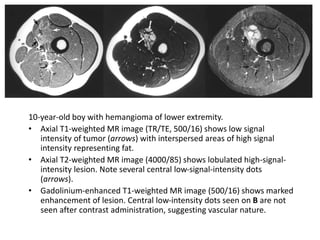 10-year-old boy with hemangioma of lower extremity. 
• Axial T1-weighted MR image (TR/TE, 500/16) shows low signal 
intensity of tumor (arrows) with interspersed areas of high signal 
intensity representing fat. 
• Axial T2-weighted MR image (4000/85) shows lobulated high-signal-intensity 
lesion. Note several central low-signal-intensity dots 
(arrows). 
• Gadolinium-enhanced T1-weighted MR image (500/16) shows marked 
enhancement of lesion. Central low-intensity dots seen on B are not 
seen after contrast administration, suggesting vascular nature. 
 