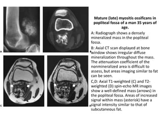 Mature (late) myositis ossificans in 
popliteal fossa of a man 35 years of 
age. 
A: Radiograph shows a densely 
mineralized mass in the popliteal 
fossa. 
B: Axial CT scan displayed at bone 
window shows irregular diffuse 
mineralization throughout the mass. 
The attenuation coefficient of the 
nonmineralized area is difficult to 
assess, but areas imaging similar to fat 
can be seen. 
C,D: Axial T1-weighted (C) and T2- 
weighted (D) spin-echo MR images 
show a well-defined mass (arrows) in 
the popliteal fossa. Areas of increased 
signal within mass (asterisk) have a 
signal intensity similar to that of 
subcutaneous fat. 
 
