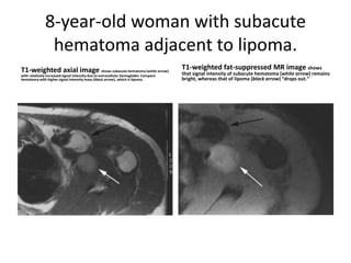 8-year-old woman with subacute 
hematoma adjacent to lipoma. 
T1-weighted axial image shows subacute hematoma (white arrow) 
with relatively increased signal intensity due to extracellular hemoglobin. Compare 
hematoma with higher signal intensity mass (black arrow), which is lipoma. 
T1-weighted fat-suppressed MR image shows 
that signal intensity of subacute hematoma (white arrow) remains 
bright, whereas that of lipoma (black arrow) “drops out.” 
 