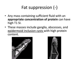 Fat suppression (-) 
• Any mass containing sufficient fluid with an 
appropriate concentration of protein can have 
high T1 SI. 
• These masses include ganglia, abscesses, and 
epidermoid inclusion cysts with high protein 
content. 
 