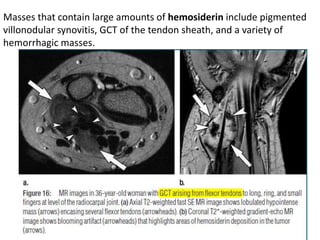 Masses that contain large amounts of hemosiderin include pigmented 
villonodular synovitis, GCT of the tendon sheath, and a variety of 
hemorrhagic masses. 
 