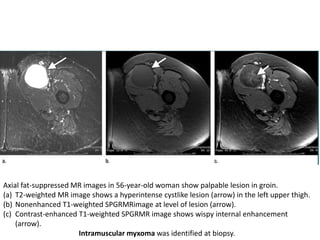 Axial fat-suppressed MR images in 56-year-old woman show palpable lesion in groin. 
(a) T2-weighted MR image shows a hyperintense cystlike lesion (arrow) in the left upper thigh. 
(b) Nonenhanced T1-weighted SPGRMRimage at level of lesion (arrow). 
(c) Contrast-enhanced T1-weighted SPGRMR image shows wispy internal enhancement 
(arrow). 
Intramuscular myxoma was identified at biopsy. 
 