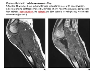 15-year-old girl with rhabdomyosarcoma of leg. 
A, Sagittal T1-weighted spin-echo MR image shows large mass with bone invasion. 
B, Corresponding contrast-enhanced MR image shows nonenhancing area compatible 
with necrosis. Bone invasion and necrosis are both specific for malignancy. Note nodal 
involvement (arrows ). 
 