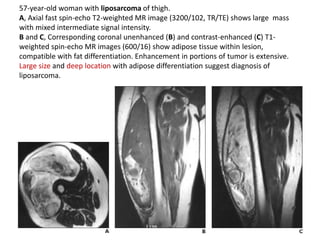 57-year-old woman with liposarcoma of thigh. 
A, Axial fast spin-echo T2-weighted MR image (3200/102, TR/TE) shows large mass 
with mixed intermediate signal intensity. 
B and C, Corresponding coronal unenhanced (B) and contrast-enhanced (C) T1- 
weighted spin-echo MR images (600/16) show adipose tissue within lesion, 
compatible with fat differentiation. Enhancement in portions of tumor is extensive. 
Large size and deep location with adipose differentiation suggest diagnosis of 
liposarcoma. 
 
