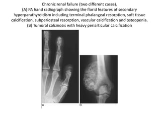 Chronic renal failure (two different cases). 
(A) PA hand radiograph showing the florid features of secondary 
hyperparathyroidism including terminal phalangeal resorption, soft tissue 
calcification, subperiosteal resorption, vascular calcification and osteopenia. 
(B) Tumoral calcinosis with heavy periarticular calcification 
 